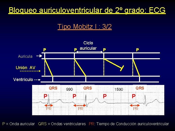 Bloqueo auriculoventricular de 2º grado: ECG Tipo Mobitz I : 3/2 Ciclo P auricular