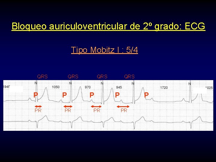 Bloqueo auriculoventricular de 2º grado: ECG Tipo Mobitz I : 5/4 QRS P PR