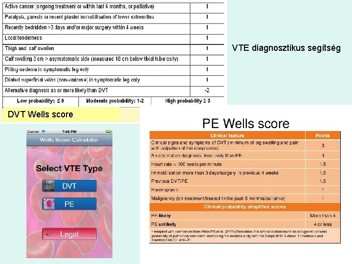 VTE diagnosztikus segítség DVT Wells score 