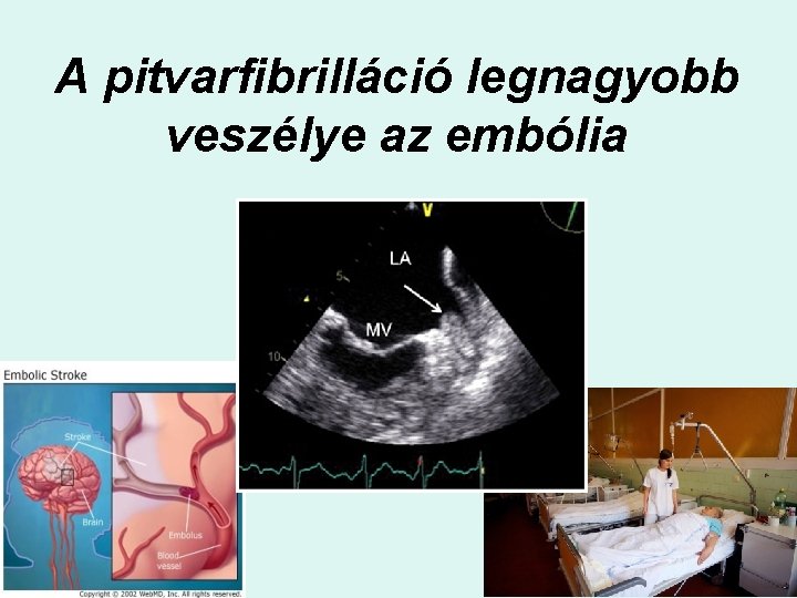 A pitvarfibrilláció legnagyobb veszélye az embólia 