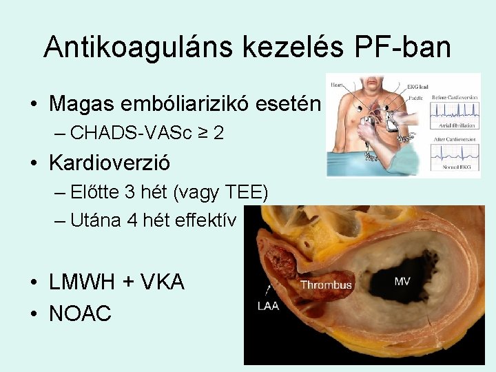 Antikoaguláns kezelés PF-ban • Magas embóliarizikó esetén – CHADS-VASc ≥ 2 • Kardioverzió –