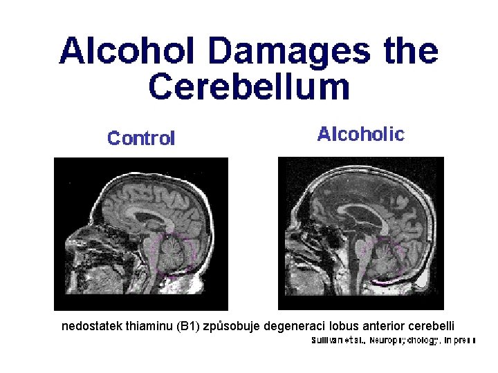 nedostatek thiaminu (B 1) způsobuje degeneraci lobus anterior cerebelli 