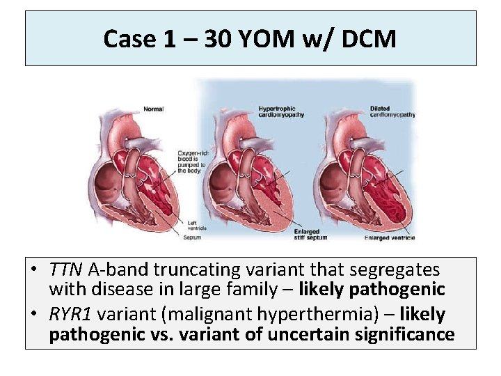 Case 1 – 30 YOM w/ DCM • TTN A-band truncating variant that segregates