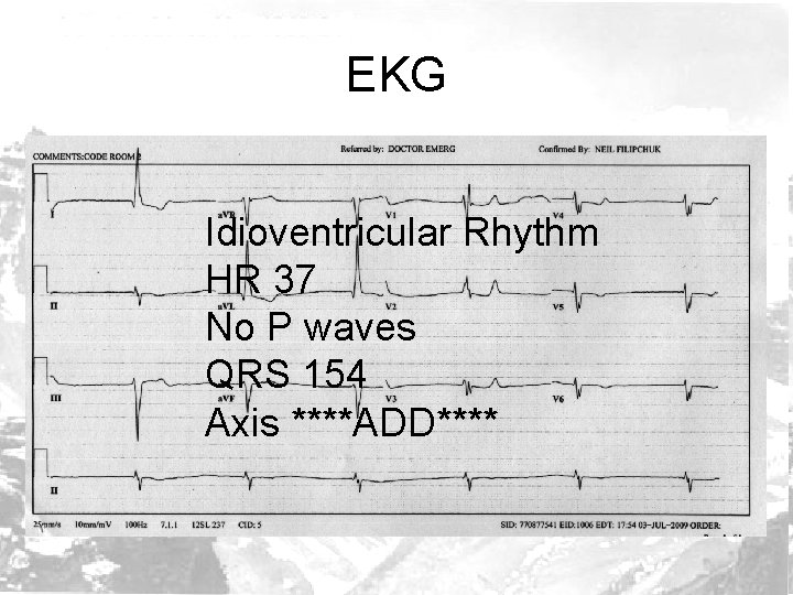 EKG Idioventricular Rhythm HR 37 No P waves QRS 154 Axis ****ADD**** 