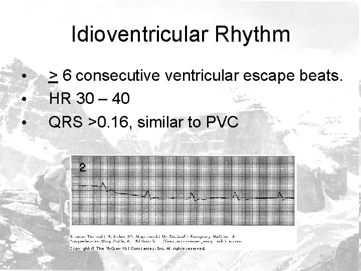 Idioventricular Rhythm • • • > 6 consecutive ventricular escape beats. HR 30 –