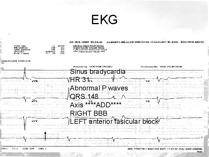 EKG Sinus bradycardia HR 31 Abnormal P waves QRS 148 Axis ****ADD**** RIGHT BBB