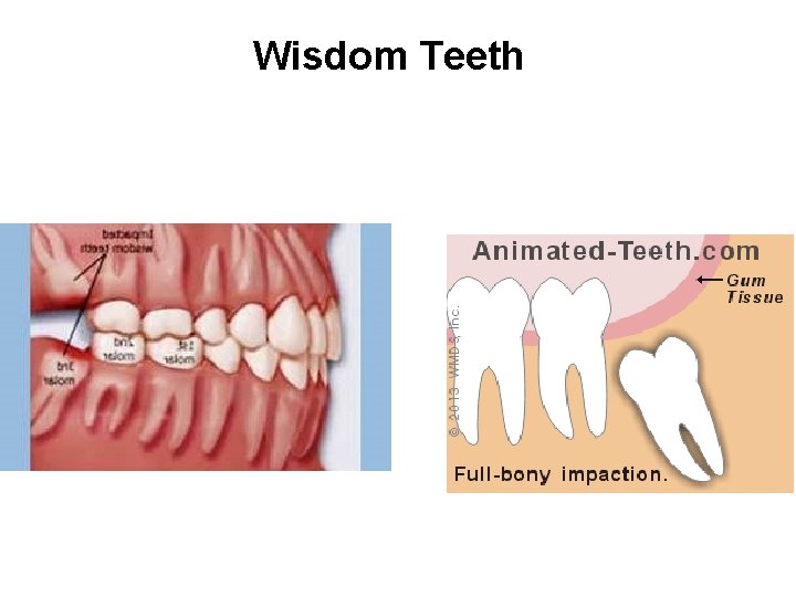 Wisdom Teeth 