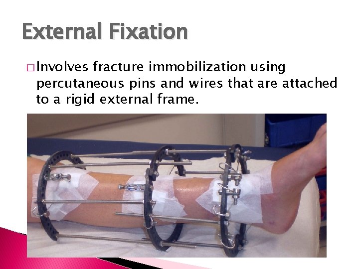 External Fixation � Involves fracture immobilization using percutaneous pins and wires that are attached External Fixation � Involves fracture immobilization using percutaneous pins and wires that are attached