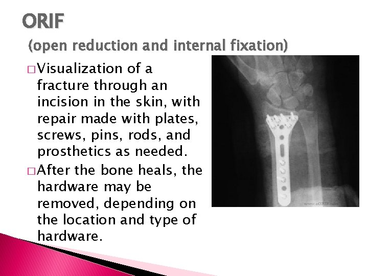 ORIF (open reduction and internal fixation) � Visualization of a fracture through an incision ORIF (open reduction and internal fixation) � Visualization of a fracture through an incision