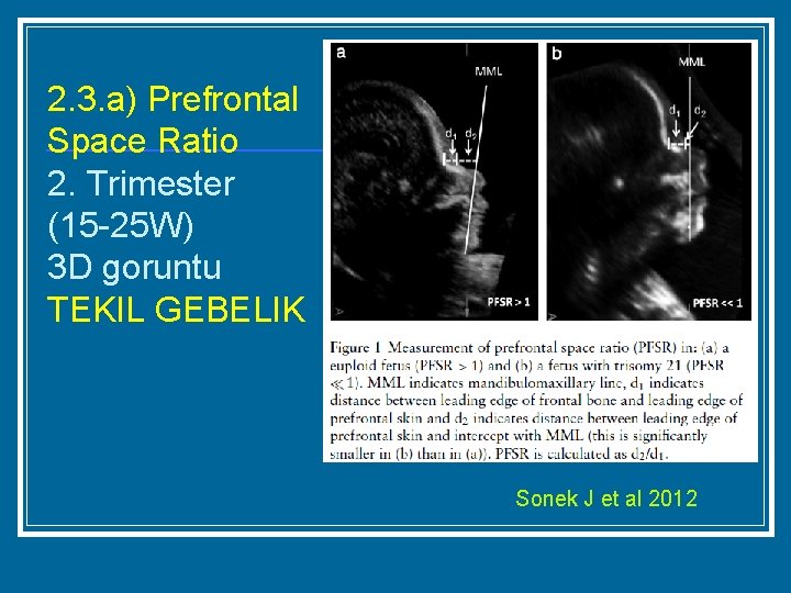 2. 3. a) Prefrontal Space Ratio 2. Trimester (15 -25 W) 3 D goruntu