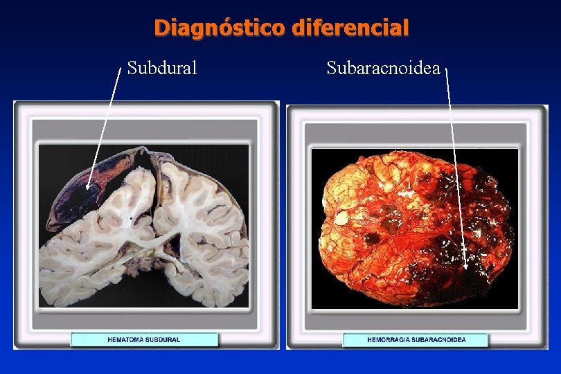 Diagnóstico diferencial Subdural Subaracnoidea 