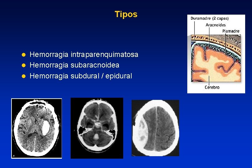 Tipos Hemorragia intraparenquimatosa l Hemorragia subaracnoidea l Hemorragia subdural / epidural l 