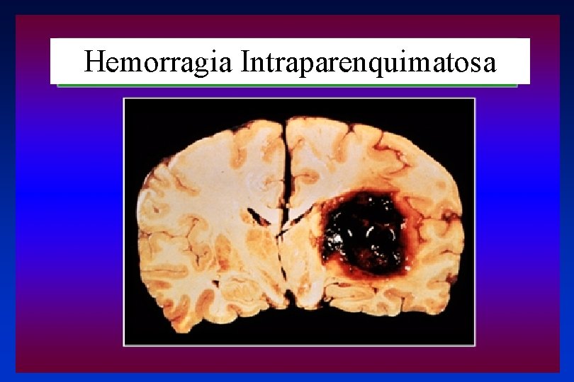 Hemorragia Intraparenquimatosa 