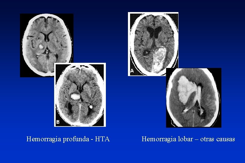 Hemorragia profunda - HTA Hemorragia lobar – otras causas 