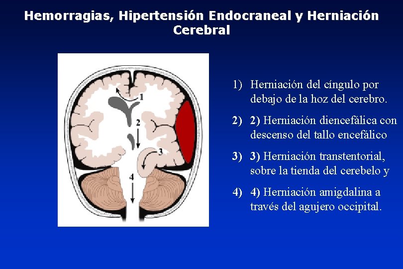 Hemorragias, Hipertensión Endocraneal y Herniación Cerebral 1) Herniación del cíngulo por debajo de la