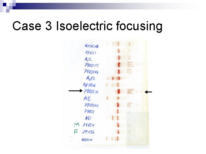 Case 3 Isoelectric focusing 