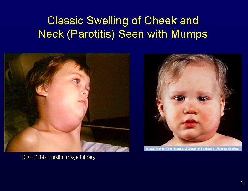 Classic Swelling of Cheek and Neck (Parotitis) Seen with Mumps CDC Public Health Image