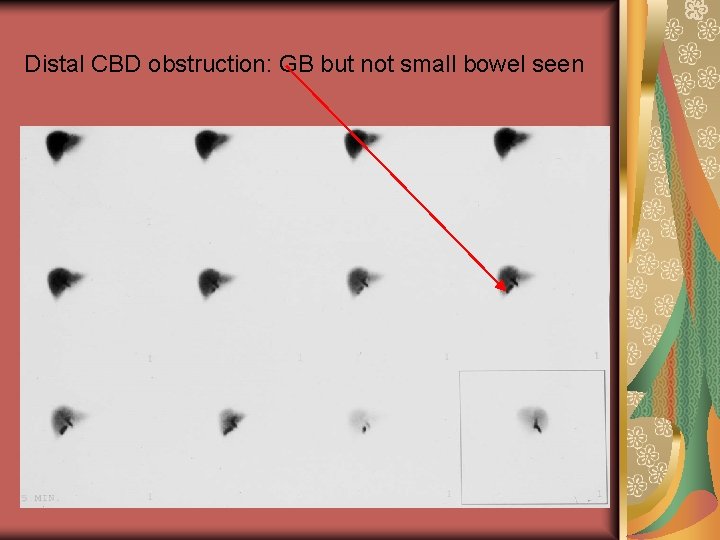 Distal CBD obstruction: GB but not small bowel seen 