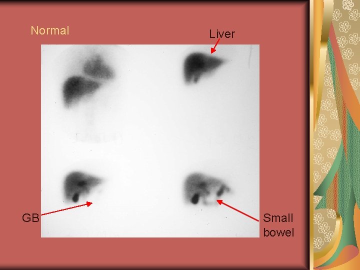 Normal GB Liver Small bowel 