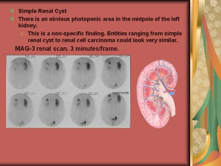 Simple Renal Cyst There is an obvious photopenic area in the midpole of the