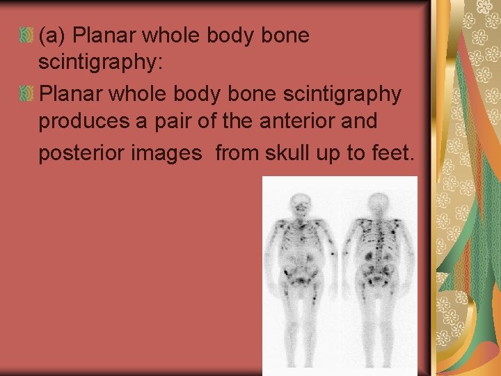 (a) Planar whole body bone scintigraphy: Planar whole body bone scintigraphy produces a pair