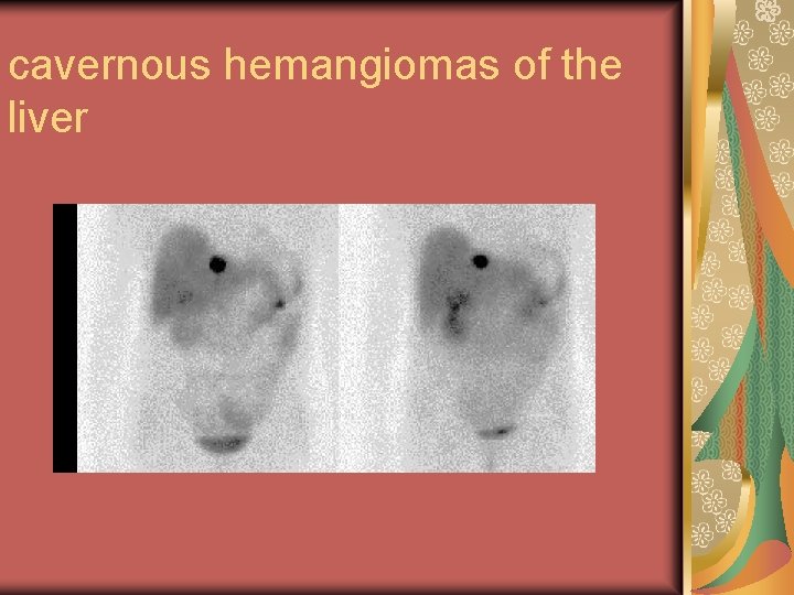 cavernous hemangiomas of the liver 