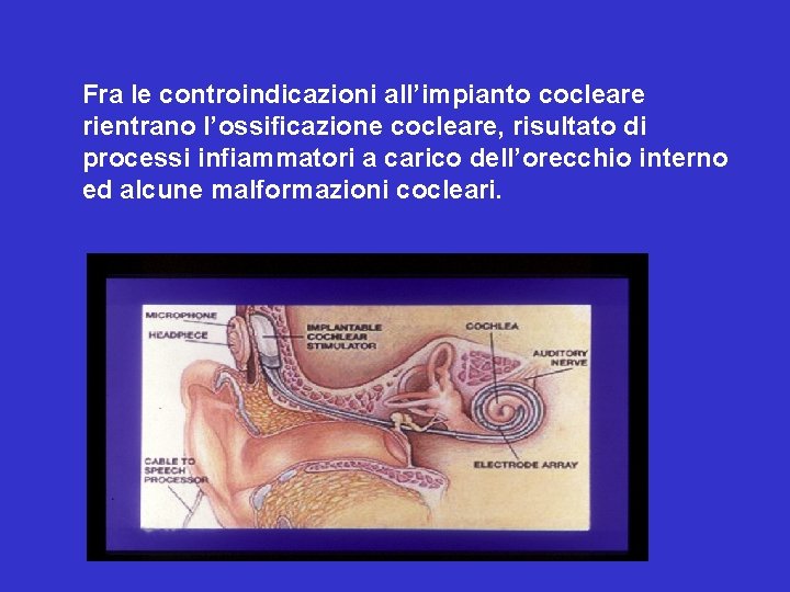 Fra le controindicazioni all’impianto cocleare rientrano l’ossificazione cocleare, risultato di processi infiammatori a carico