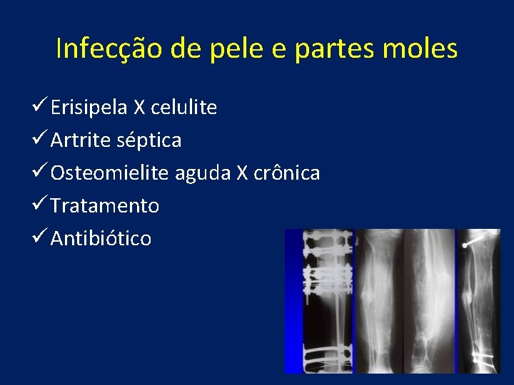 Infecção de pele e partes moles ü Erisipela X celulite ü Artrite séptica ü