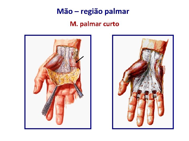 Mão – região palmar M. palmar curto 