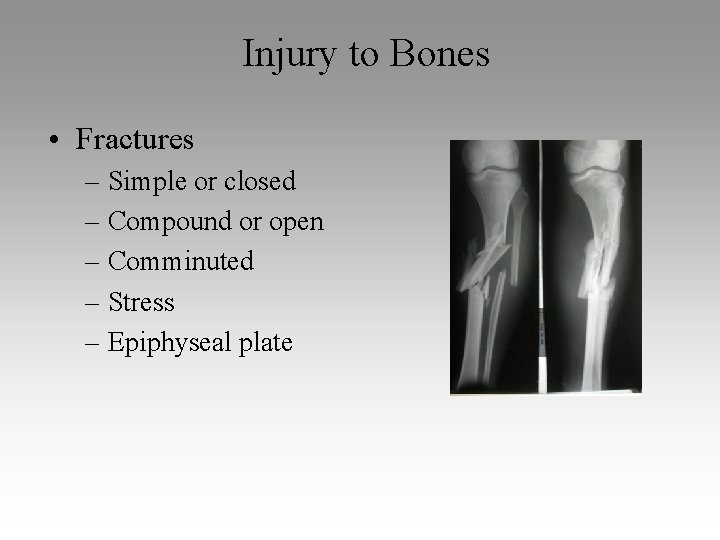 Injury to Bones • Fractures – Simple or closed – Compound or open –