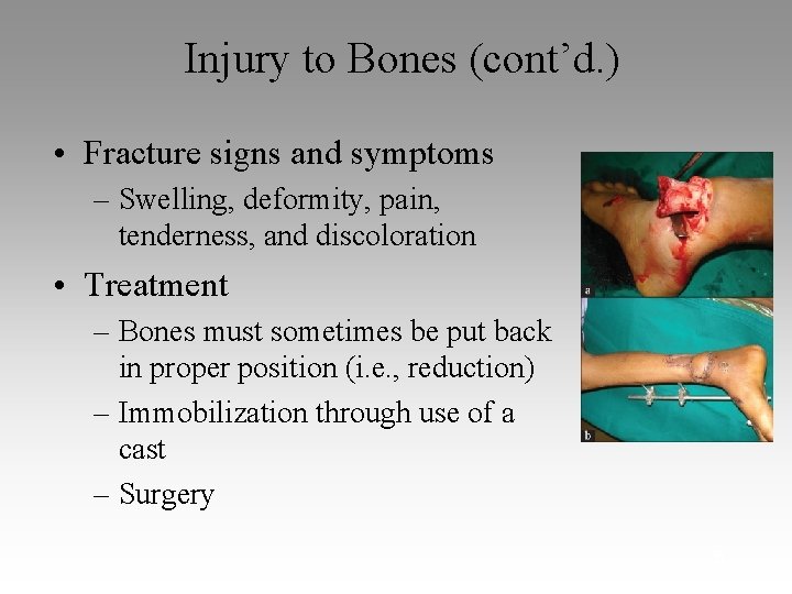 Injury to Bones (cont’d. ) • Fracture signs and symptoms – Swelling, deformity, pain,