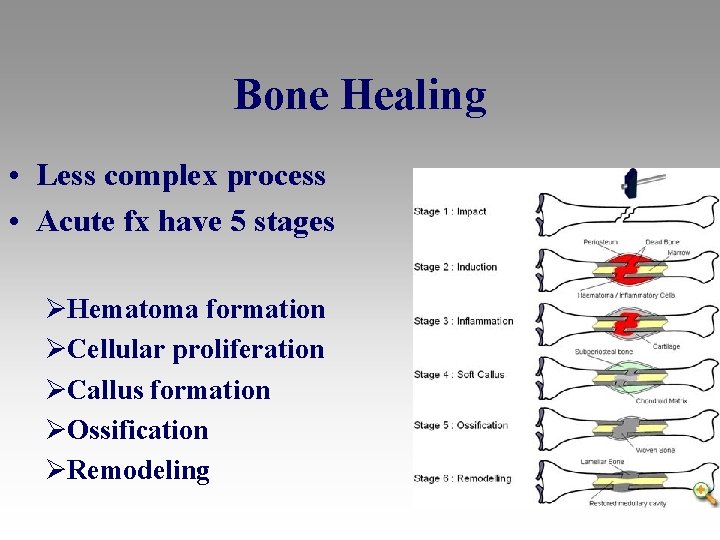 Bone Healing • Less complex process • Acute fx have 5 stages ØHematoma formation