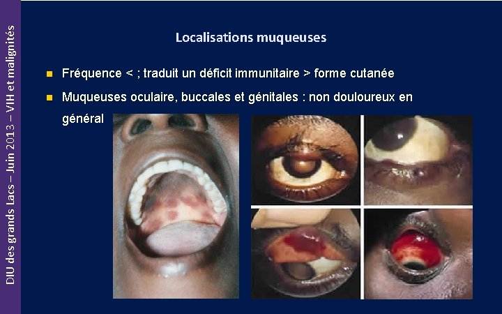 DIU des grands Lacs – Juin 2013 – VIH et malignités Localisations muqueuses n