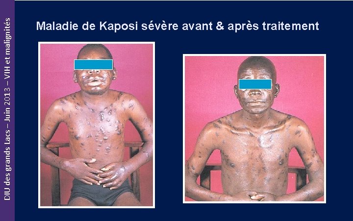 DIU des grands Lacs – Juin 2013 – VIH et malignités Maladie de Kaposi