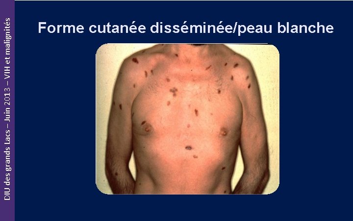 DIU des grands Lacs – Juin 2013 – VIH et malignités Forme cutanée disséminée/peau