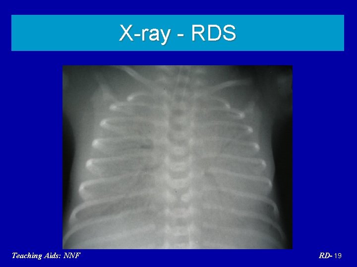 X-ray - RDS Teaching Aids: NNF RD- 19 