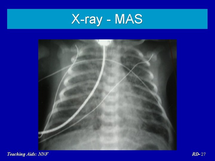 X-ray - MAS Teaching Aids: NNF RD- 27 