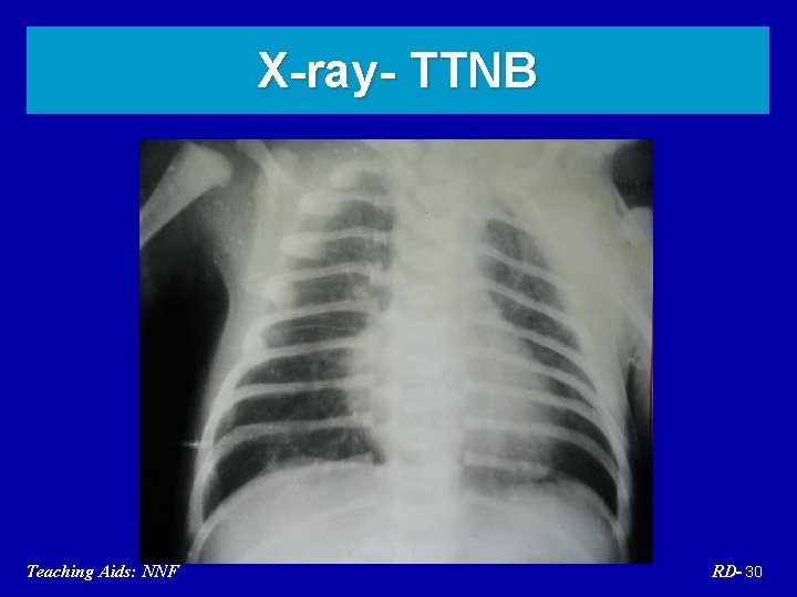 X-ray- TTNB Teaching Aids: NNF RD- 30 