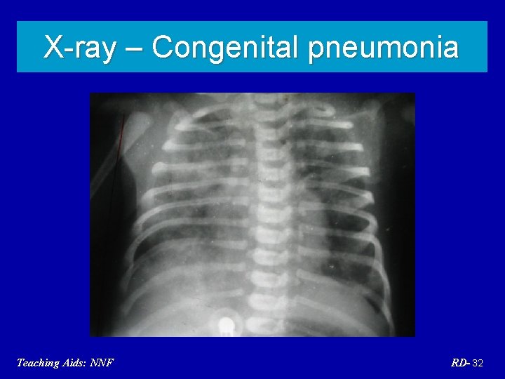 X-ray – Congenital pneumonia Teaching Aids: NNF RD- 32 