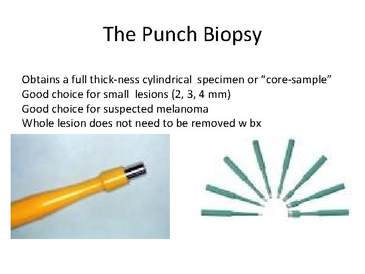 The Punch Biopsy Obtains a full thick-ness cylindrical specimen or “core-sample” Good choice for