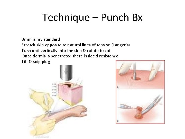 Technique – Punch Bx 3 mm is my standard Stretch skin opposite to natural