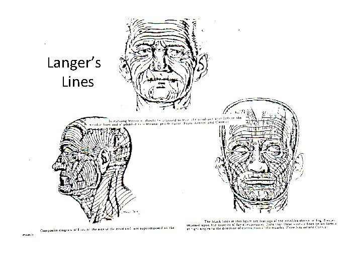 Langer’s Lines 