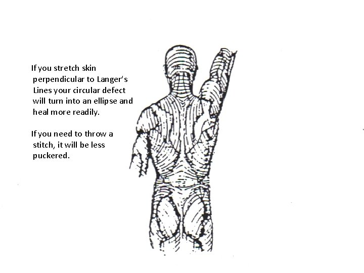 If you stretch skin perpendicular to Langer’s Lines your circular defect will turn into