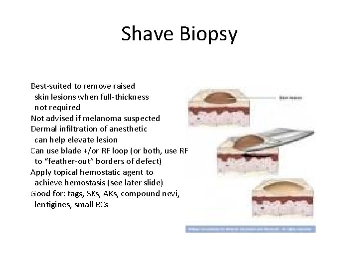 Shave Biopsy Best-suited to remove raised skin lesions when full-thickness not required Not advised
