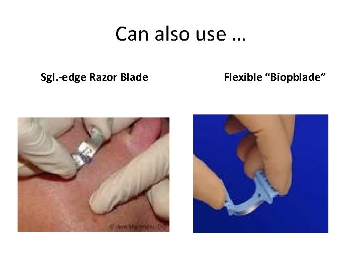 Can also use … Sgl. -edge Razor Blade Flexible “Biopblade” 