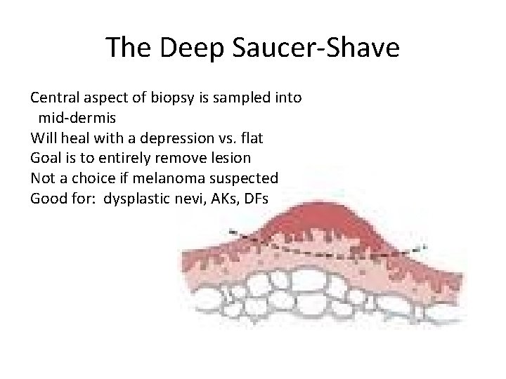 The Deep Saucer-Shave Central aspect of biopsy is sampled into mid-dermis Will heal with