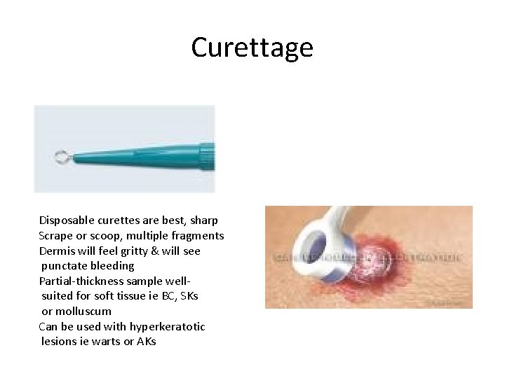 Curettage Disposable curettes are best, sharp Scrape or scoop, multiple fragments Dermis will feel