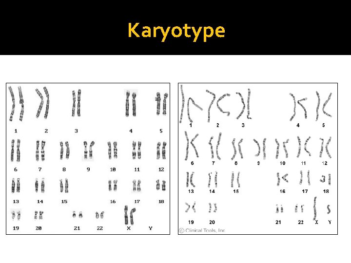 Karyotype Normal Female Normal Male Karyotype Normal Female Normal Male