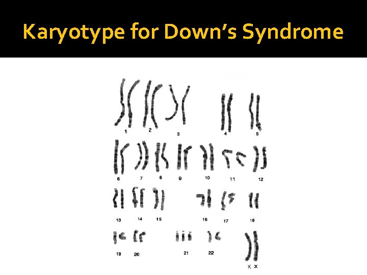 Karyotype for Down’s Syndrome 