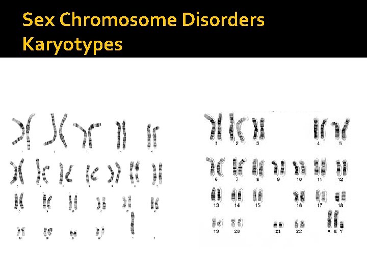 Sex Chromosome Disorders Karyotypes Turner’s Syndrome 45 XO Kleinfelter’s Syndrome 
